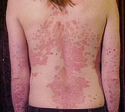 Photo of Trattamento per la scabbia caucasica