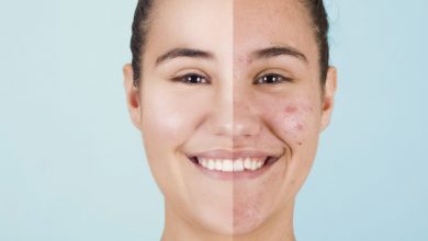 Photo of Acne: un rimedio naturale per combatterla