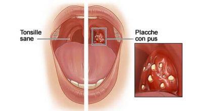 Photo of Infezione alla gola, un rimedio naturale e semplice per combatterla