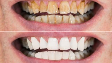 Photo of Rimedi casalinghi per lo sbiancamento dei denti