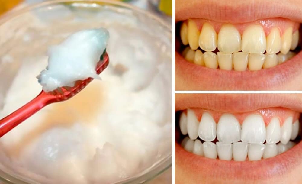 Rimedio casalingo per sbiancare i denti in modo naturale Il Giardino